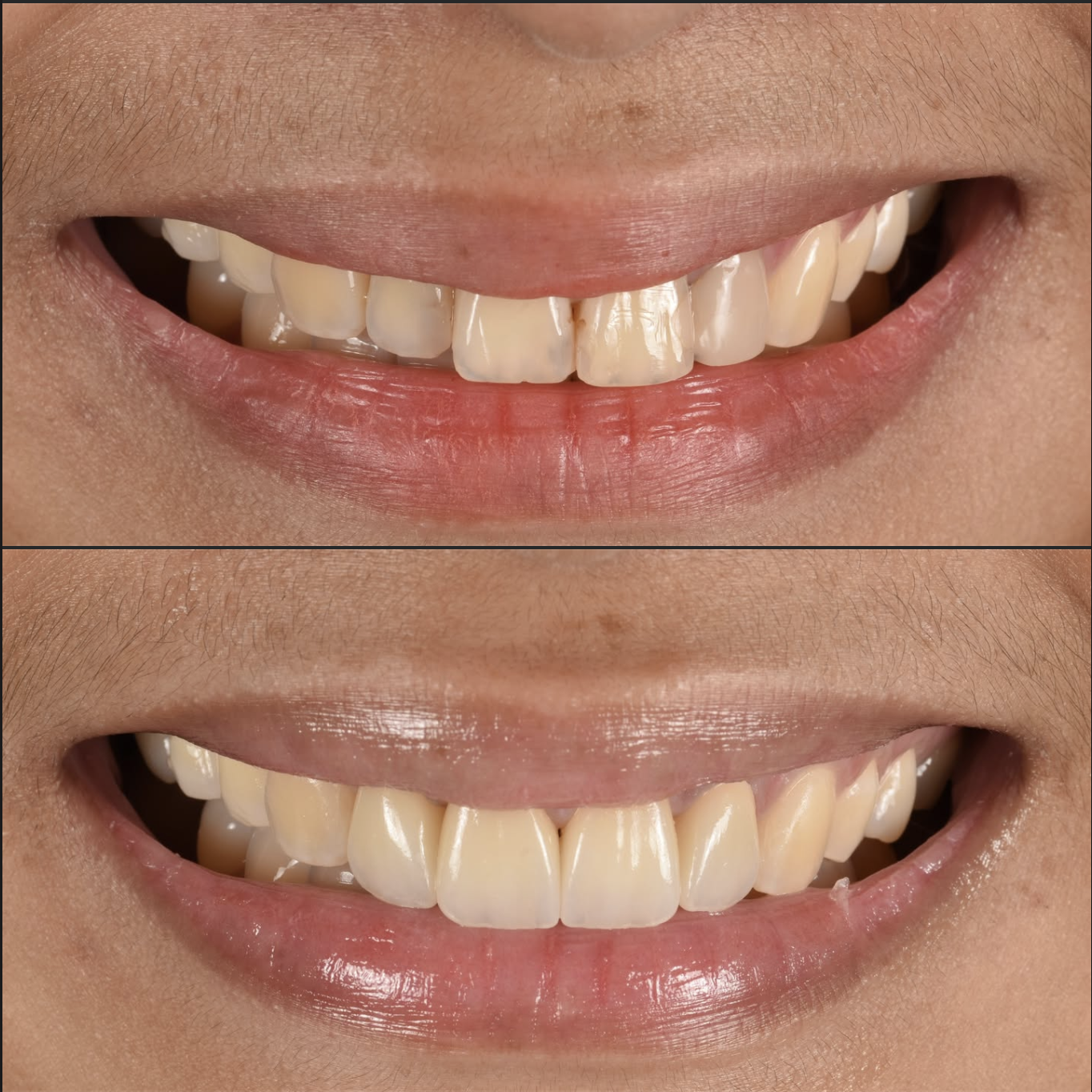 Smile treatment before and after result