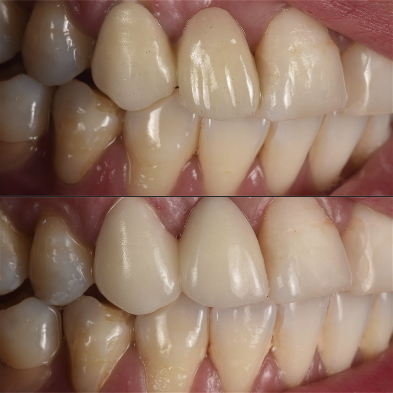 Close-up dental treatment before and after result