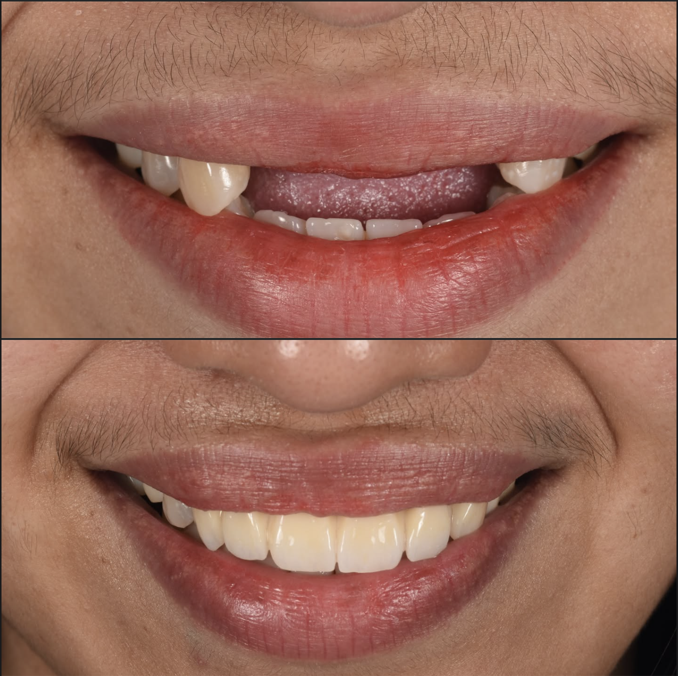 Dental treatment before and after result